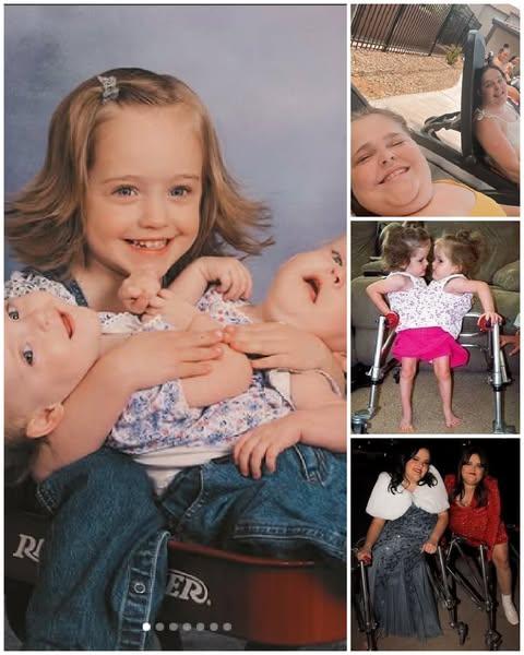Formerly Conjoined Twins Grew Up and Took Different Paths