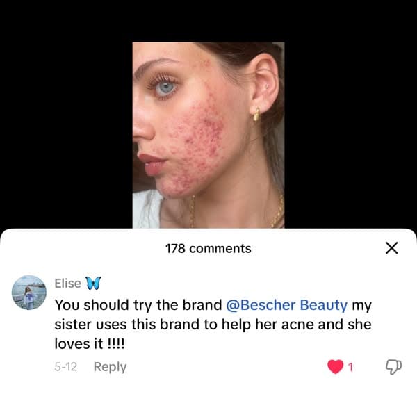 Beat Adult Acne