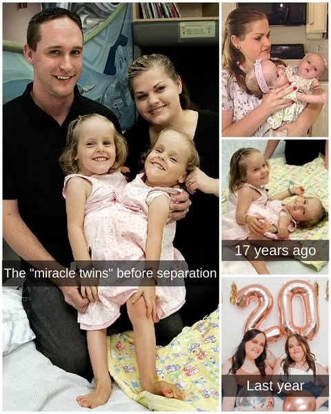 These Formerly Conjoined Twins Are All Grown Up, This Is Them Now