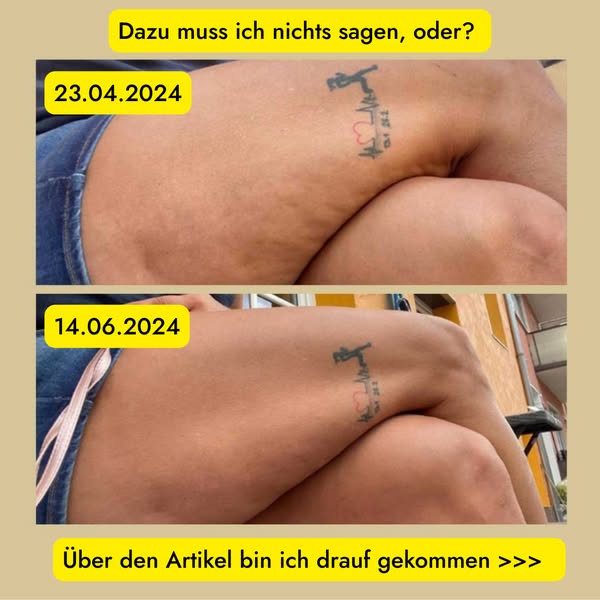 Wissenschaftlich belegt: So kann Cellulite wirklich reduziert werden.