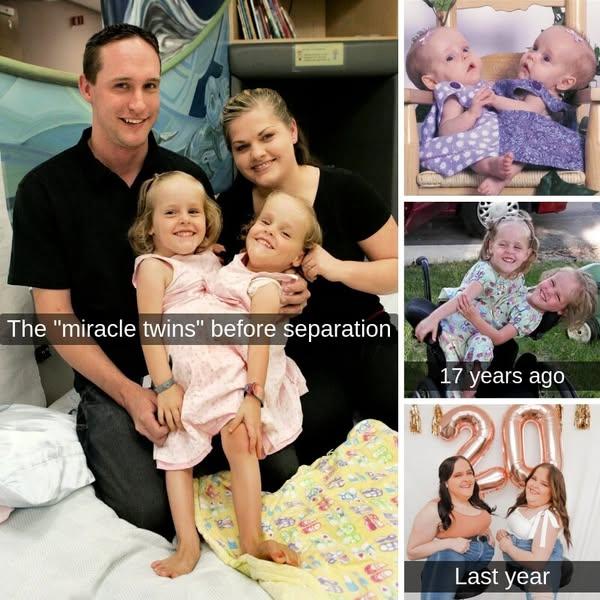 These Formerly Conjoined Twins Are All Grown Up, This Is What Happened To Them