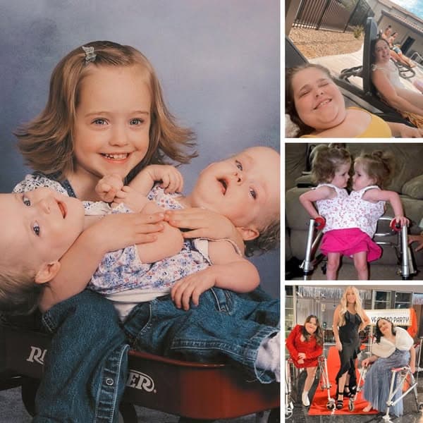 These Formerly Conjoined Twins Are All Grown Up, This Is Them Now