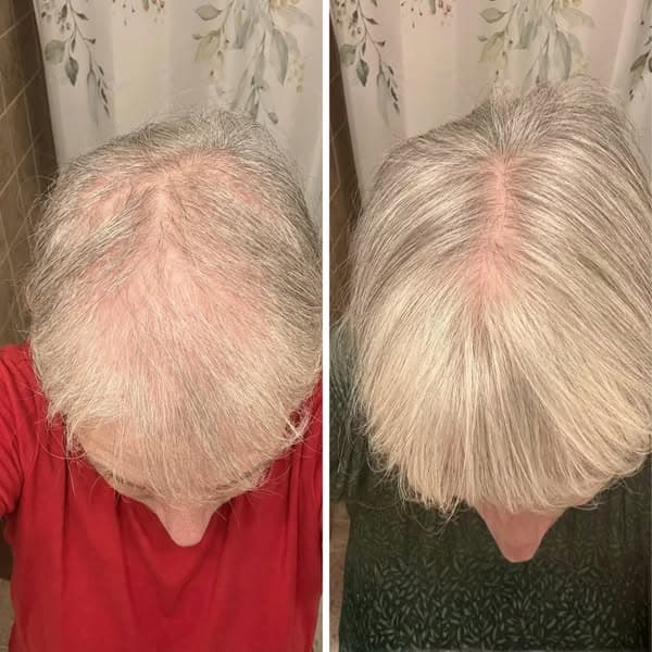 The Real Reason Your Hair Keeps Thinning - No One Talks About This Hormone