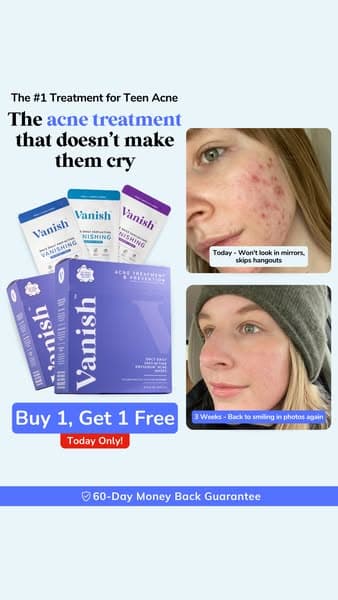 #1 Acne Treatment for Teens (7 Reasons Why)