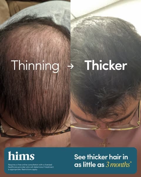 Hair Loss? Fight Back with Hims 💪
