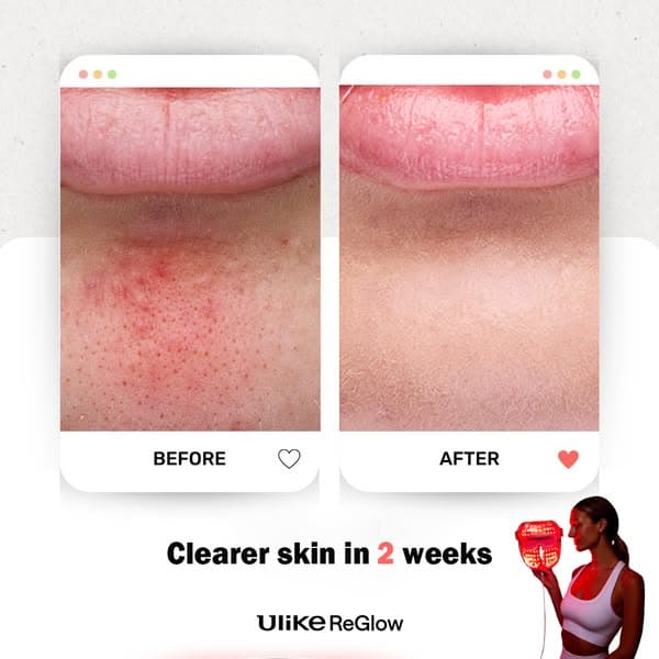 4-in-1 Skin Renewal LED Light Therapy Mask