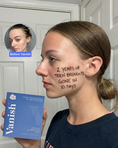 #1 Acne Treatment for Teens (7 Reasons Why)